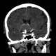 Aneurysm of internal carotid artery, left: CT - Computed tomography